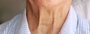 Throat wrinkles (“banding”)