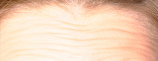 Horizontal forehead wrinkles