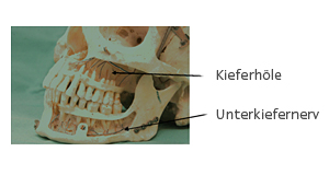 Knochenschwund