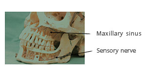 Bone loss after tooth extraction