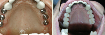 Implants on both sides of the upper jaw