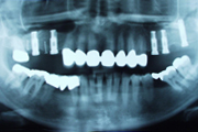 X-ray image of implants