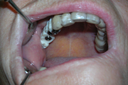 Drilling guide in the patient’s mouth