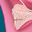 Patienteneigener Knochenblock mit Schraube fixiert