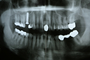 POrthopantomogram (OPG)