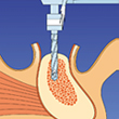 Präparation des Implantatbettes mit Bohrern zunehmenden Kalibers