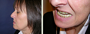 Sagittal Malalignment - Short Upper Jaw