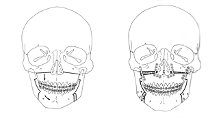 Procedure: combined malalignments