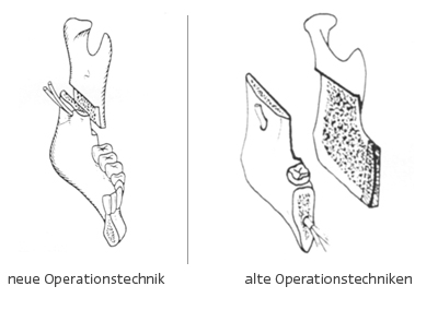 Operationsmethode Unterkiefer