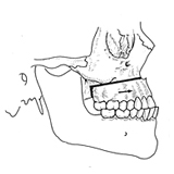 Procedure: Sagittal Malalignment