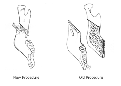 Procedure: Underbite (mandibular prognathism)