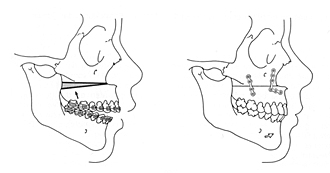 Procedure: Vertical Plane