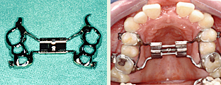 Stretching phase - palate seam expansion